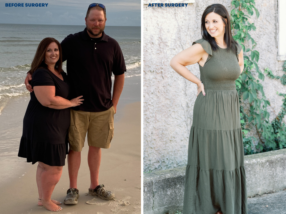 before-after-bariatric